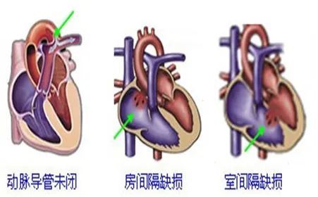 先天性心脏病有哪些危害