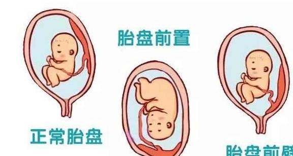 胎盘植入丨解读胎盘植入的危害与预防