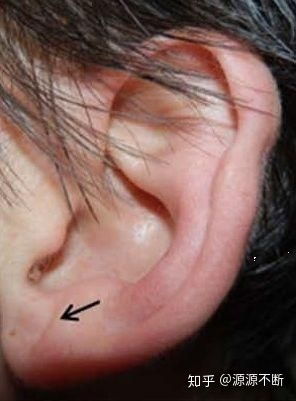 耳朵有褶皱的人更容易得心脏病吗 