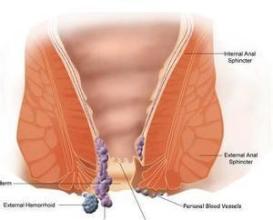 混合痔用什么药(混合痔用什么药最好)