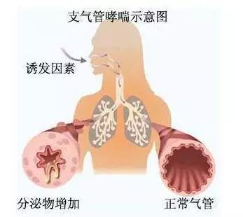 治疗支气管哮喘偏方