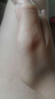 我的手被狗咬伤了,已经超过24小时了,是这个样子的 下图 有什么危险吗 