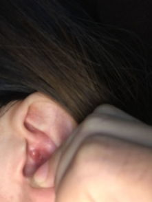 我耳朵里长了个痘痘一样的红的看图片碰了它耳朵就疼之前长过又好了这次又长了左边耳朵长右耳部长 