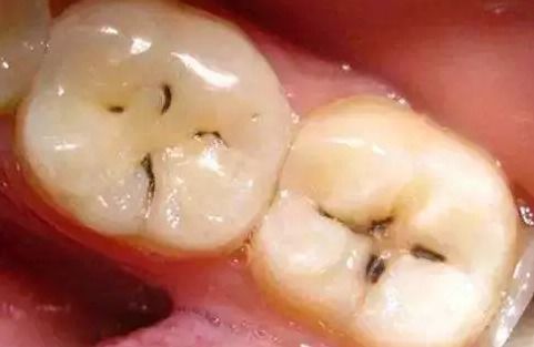 益开食讲蛀牙 形成蛀牙的4因素,早控制早受益