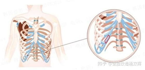 鼻子整形怎么做 那种方法效果好 