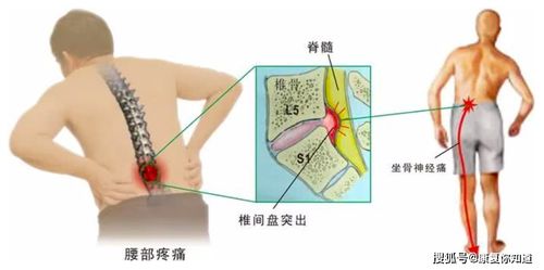 明明是腰椎间盘突出,为什么会腿疼