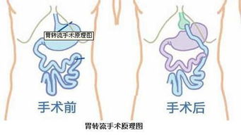 2型糖尿病应该怎么治疗 