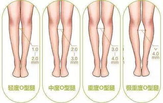 求实瑜伽丨如何让O型腿变直 你需要看看这篇O型腿理疗 瑜伽体式方案