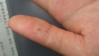 这个大拇指上的类似痣一样的东西,大概半个月前长的,刚开始没那么大,然后没过几天就 长大了 ,而且形 