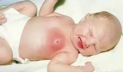 新生儿竟得乳腺炎,只因奶奶挤乳头 