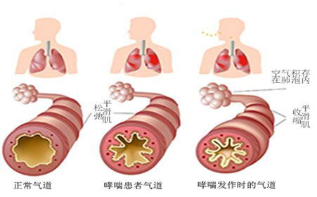 气喘病的临床症状