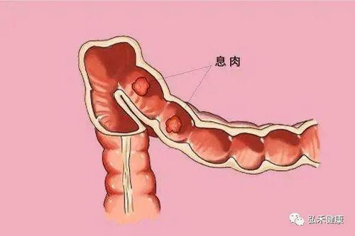 发现肠息肉日常该注意什么