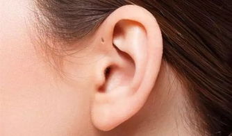 耳朵上有个小洞洞是怎么回事,耳朵上有个小洞是富贵病？要小心“耳前瘘管”
