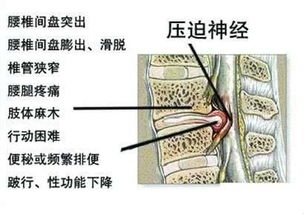 治疗腰间盘突出偏方