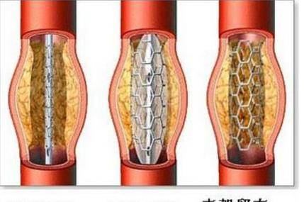 心脏支架后如何快速恢复 能不能活动 心血管专家明确回答