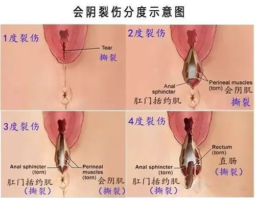 陈旧性会阴Ⅳ度裂伤25年 巨大子宫肌瘤,一台手术帮她告别难言苦痛 