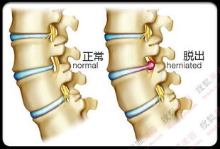 腰间盘突出可以买商业医疗险吗 (腰间盘突出手术保险有必要买吗)