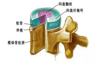 腰椎间盘突出症怎么治疗才能够不复发