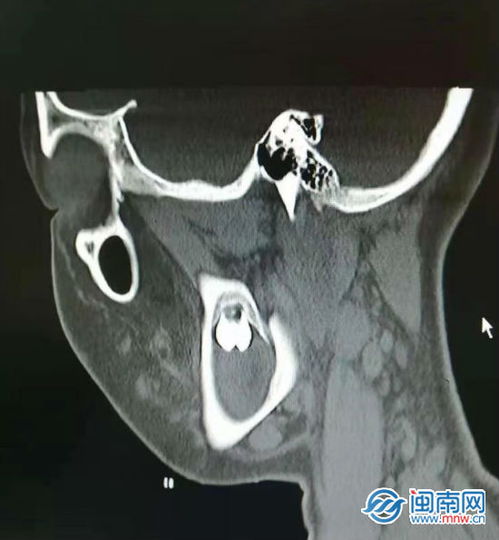 漳州 16岁女孩牙龈疼痛流脓 竟是智齿惹的祸