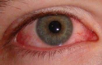眼睛发病的10种信号 眼球凸出或患甲亢