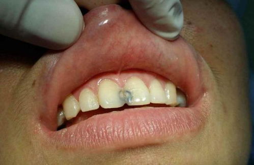 牙齿上有黑点是蛀牙吗 