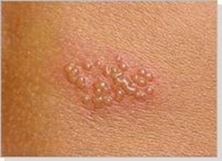单纯疱疹的症状有哪些皮肤癌怎样诊断 皮肤癌如何诊断 皮肤癌的诊断