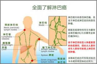 淋巴癌晚期不治疗还能活多久