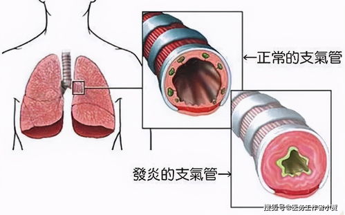 老慢支 咳嗽 咳痰频发 医生教你如何止咳化痰