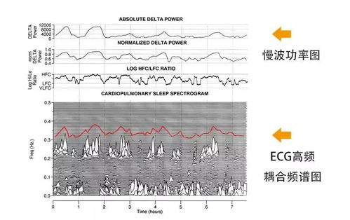 孙洪强psg多导睡眠监测在精神科的应用 米粒分享网 Mi6fx Com