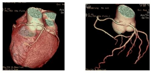 你真的懂冠脉CTA吗