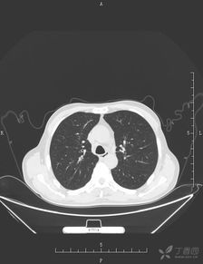 胸部CT