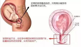 医学 托起万千妇女母亲梦的腹腔镜下宫颈环扎术 