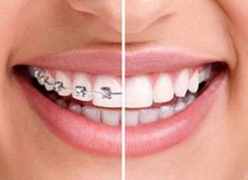 大连齿医生口腔科普 矫正牙齿会伤害你的牙神经吗