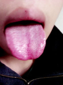 舌头上有小红点,又有白苔,中间还有裂痕,都有神马火啊 平时怎么预防啊 