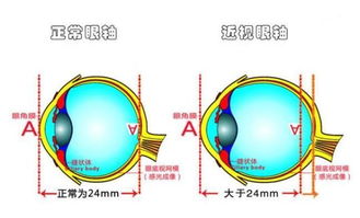 网络近视知识