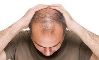 为什么男性更容易脱发 男性脱发该怎么治疗