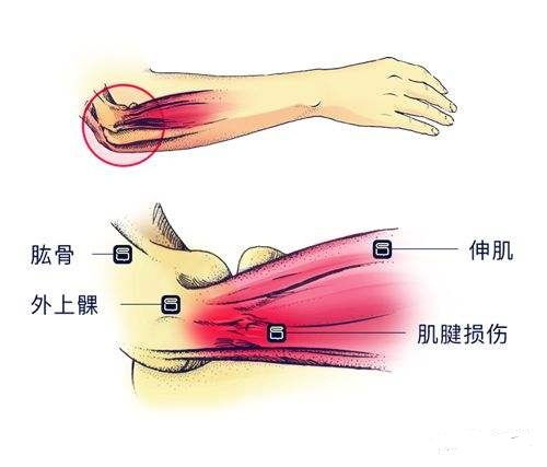 网球肘的治疗偏方