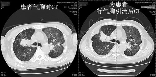 什么是慢阻肺