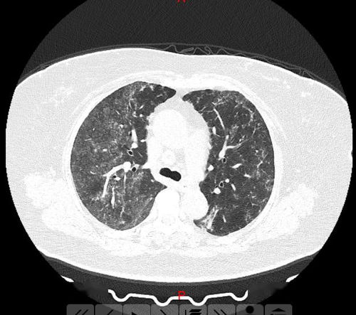 内蒙2女子肺部CT均呈毛玻璃影 检查结果令人震惊 .