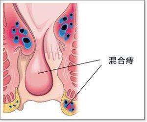 混合痔是什么意思 混合痔必须要做手术吗