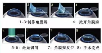 近视的你,暑假逆袭攻略来了 华山眼科屈光手术特大优惠活动即将来袭...... 文内有福利