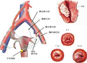 宫颈癌前病变