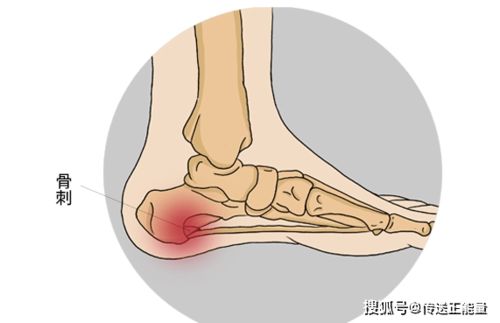 脚后跟疼痛怎么回事