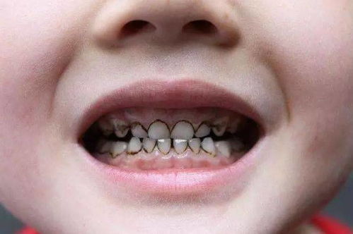 4岁孩子满嘴 黑牙 ,医生提醒 如果孩子有这种习惯,尽早改掉