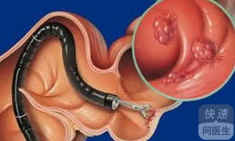 肠胃息肉专家建议手术切除 一定要手术切除吗