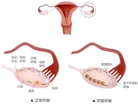 多囊卵巢综合征,更适合自然受孕还是试管婴儿