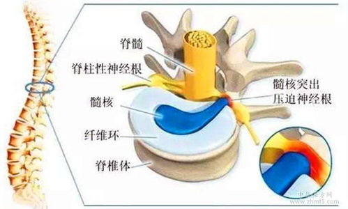 腰间盘突出治疗偏方