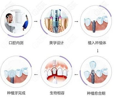 瑞士亲水iti从植入种植体到完成上冠上牙一般要多长时间