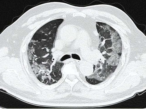 咳嗽 气短 胸闷 高精度CT筛查关爱 阳康 肺部健康