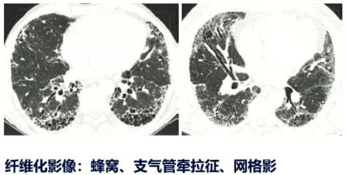 赵岩教授 关注间质性肺炎的进行性纤维化表型